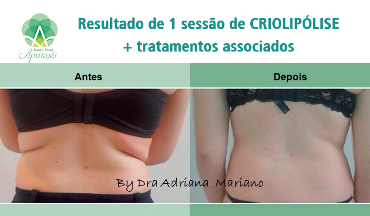 Criolipólise em Perdizes Saúde & Pilates Apinajés