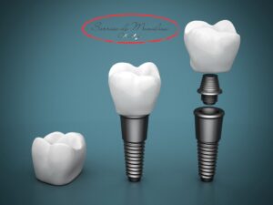 Implantes Dentais em São Miguel Paulista - Clínica Odontológica Sorriso de Monalisa